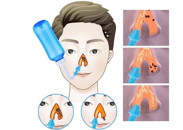 Rửa mũi bằng nước muối giúp loại bỏ dịch nhầy ứ đọng